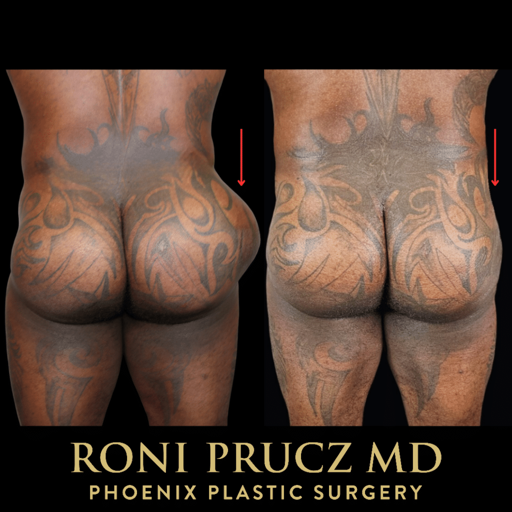 Before and After Photo of Buttock Implant Removal Phoenix Arizona