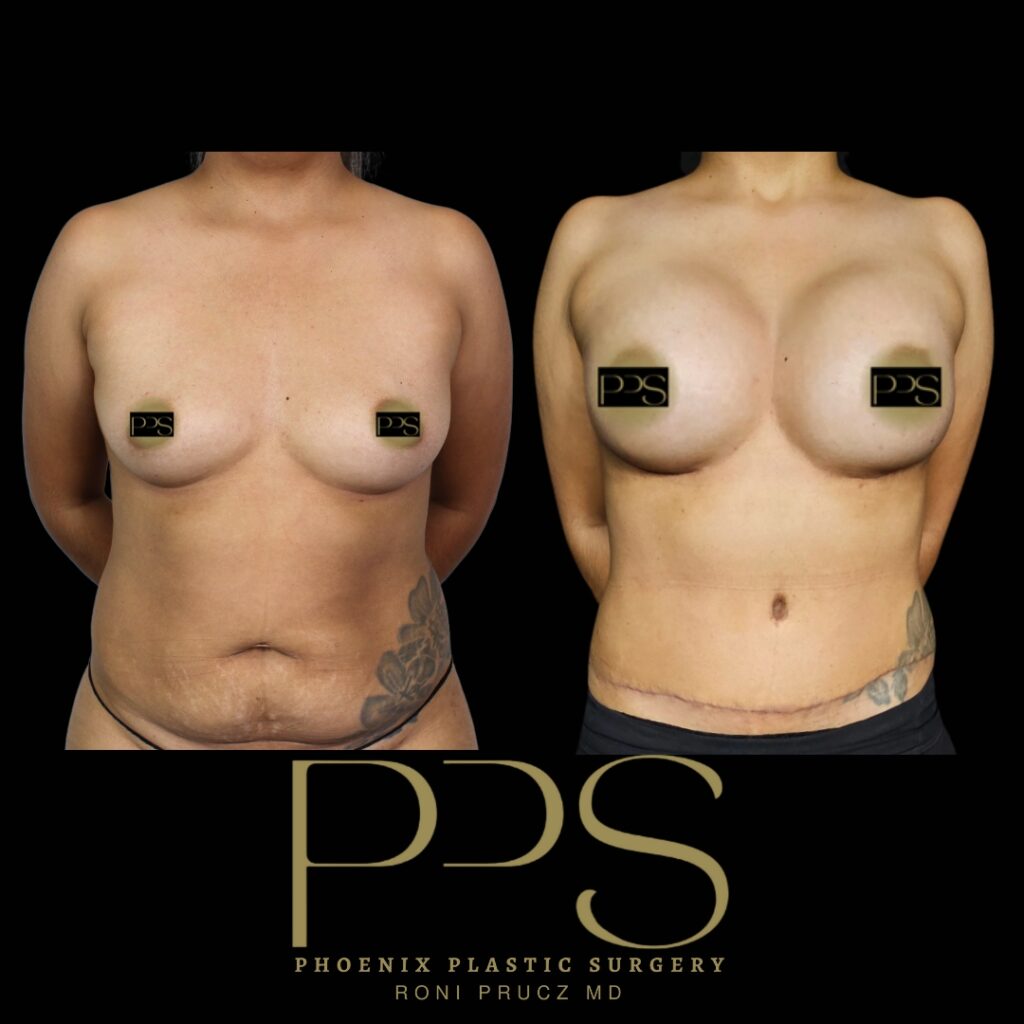 Before and After Photo of Mommy Makeover with Breast Lift with Implants and Tummy Tuck Phoenix Arizona