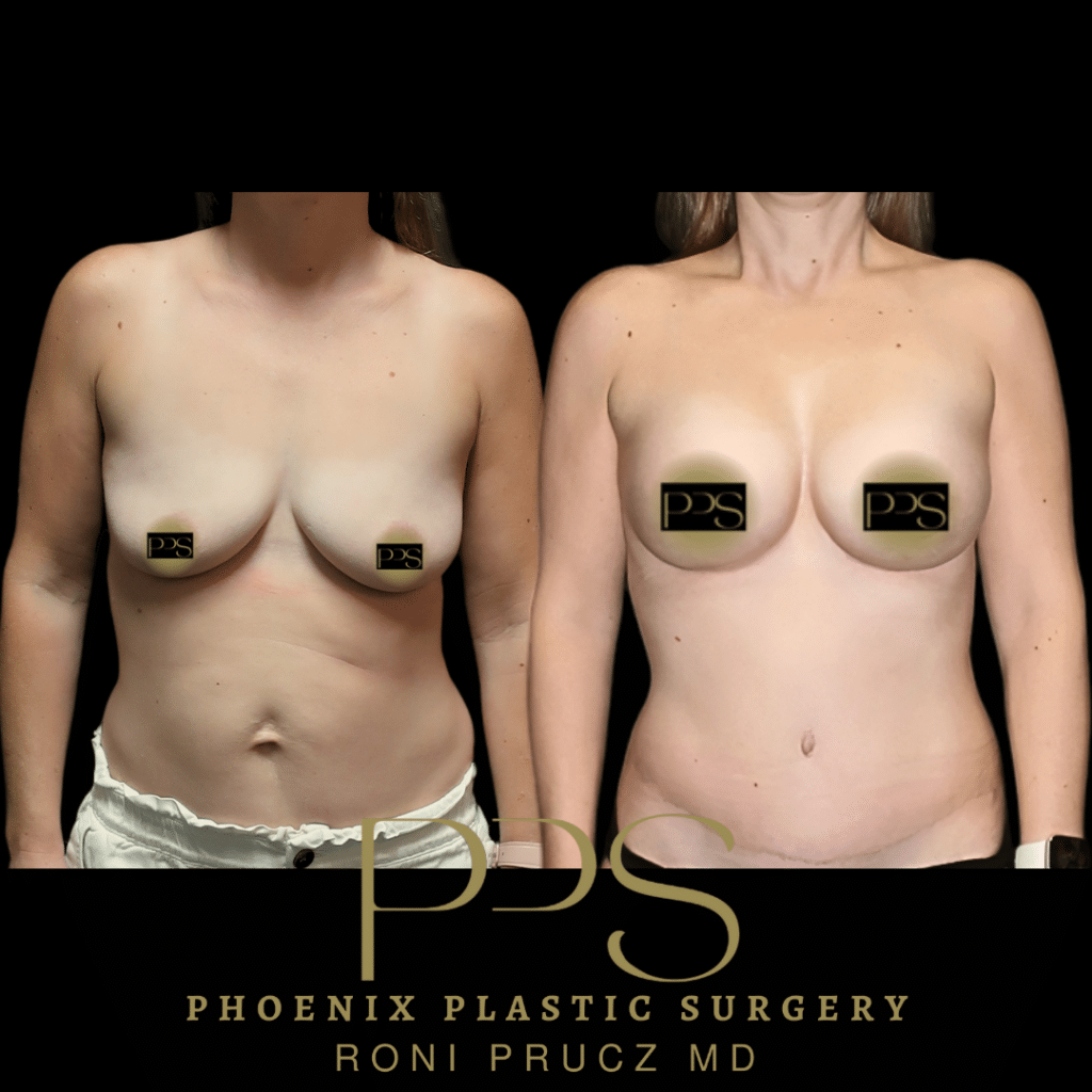 Before and After Photo of Mommy Makeover with Breast Lift and Tummy Tuck at Phoenix Plastic Surgery
