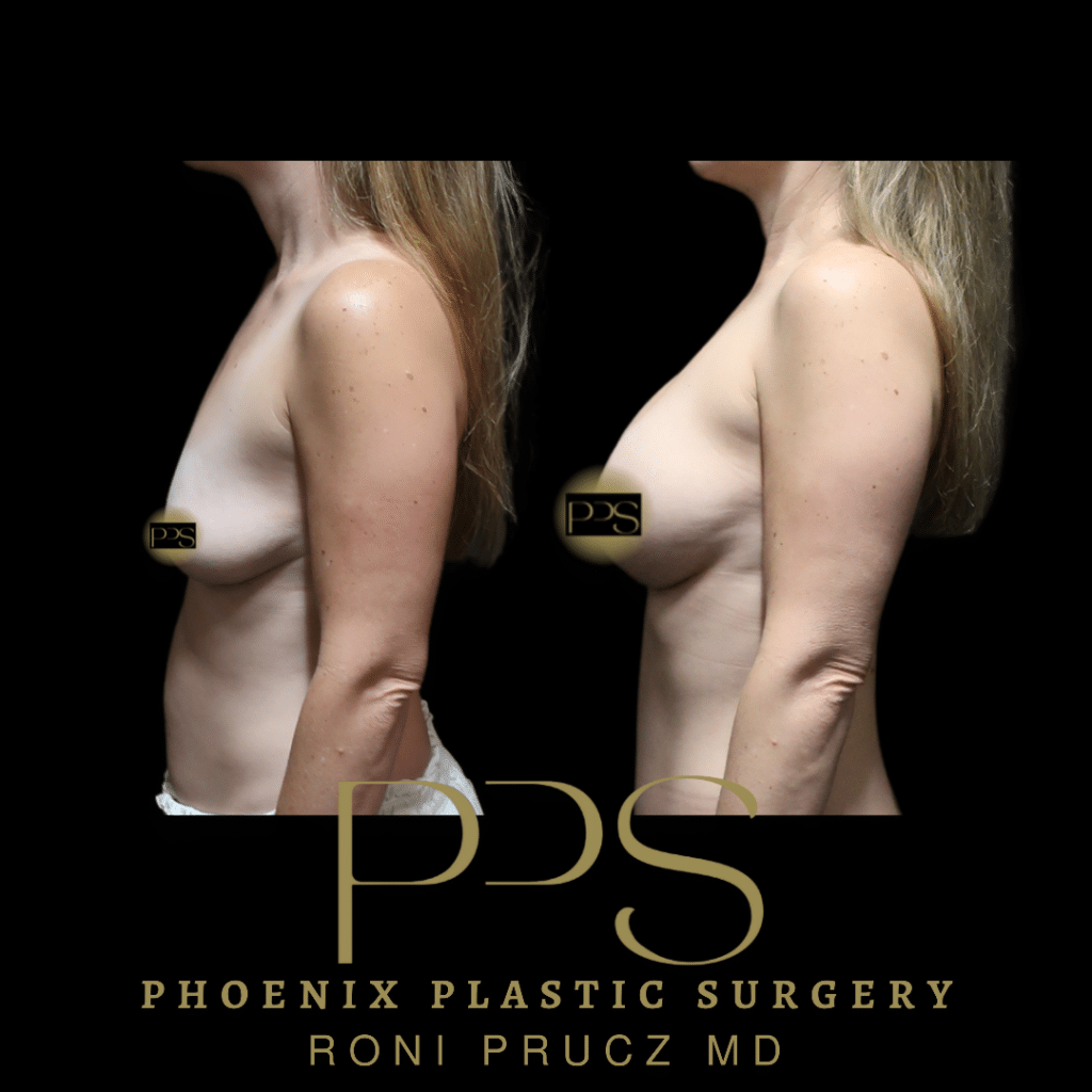 Before and After Photo of Breast Lift at Phoenix Plastic Surgery