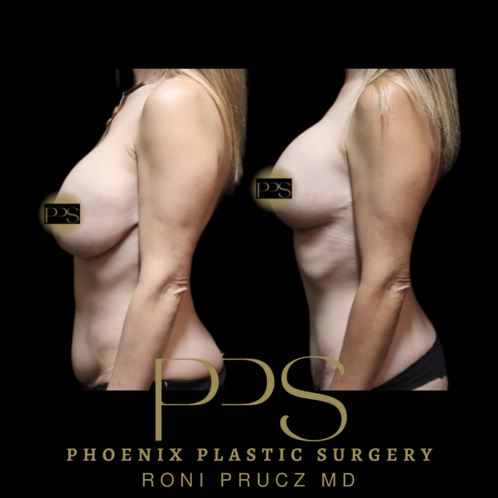 Before and After Photo of Breast Lift at Phoenix Plastic Surgery