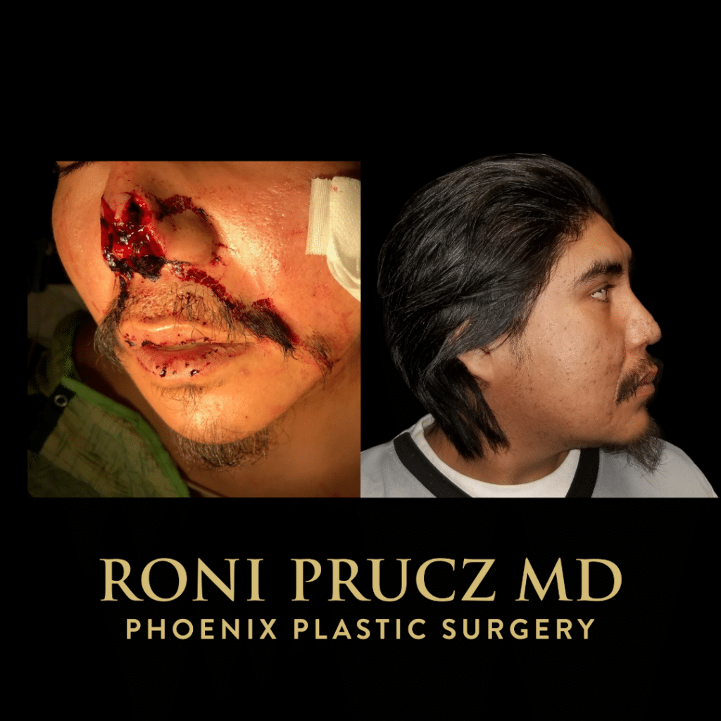 Before and After Photo of nasal reconstruction after dog bite injury at Phoenix Plastic Surgery