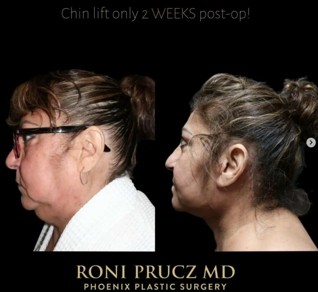 Before and After Photo of Female Neck Lift with Liposuction Phoenix Arizona