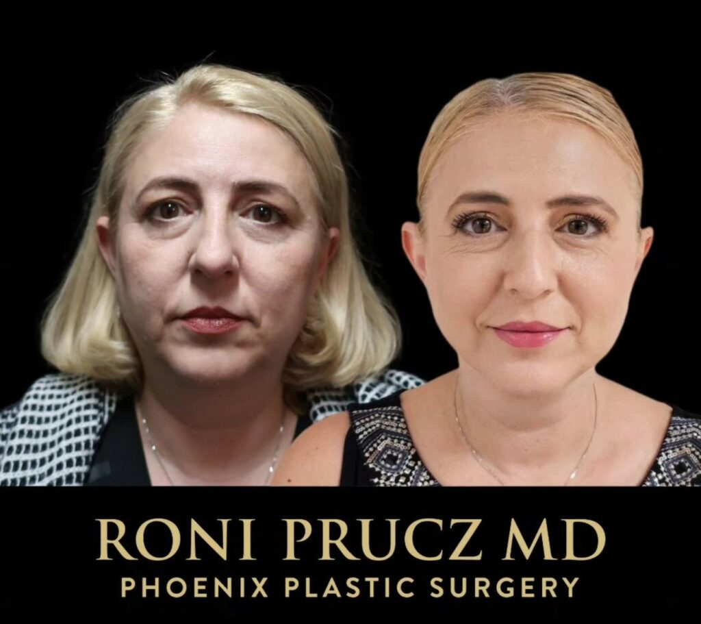 Before and After Photo of Female Upper Blepharoplasty and Chin Liposuction Scottsdale Arizona