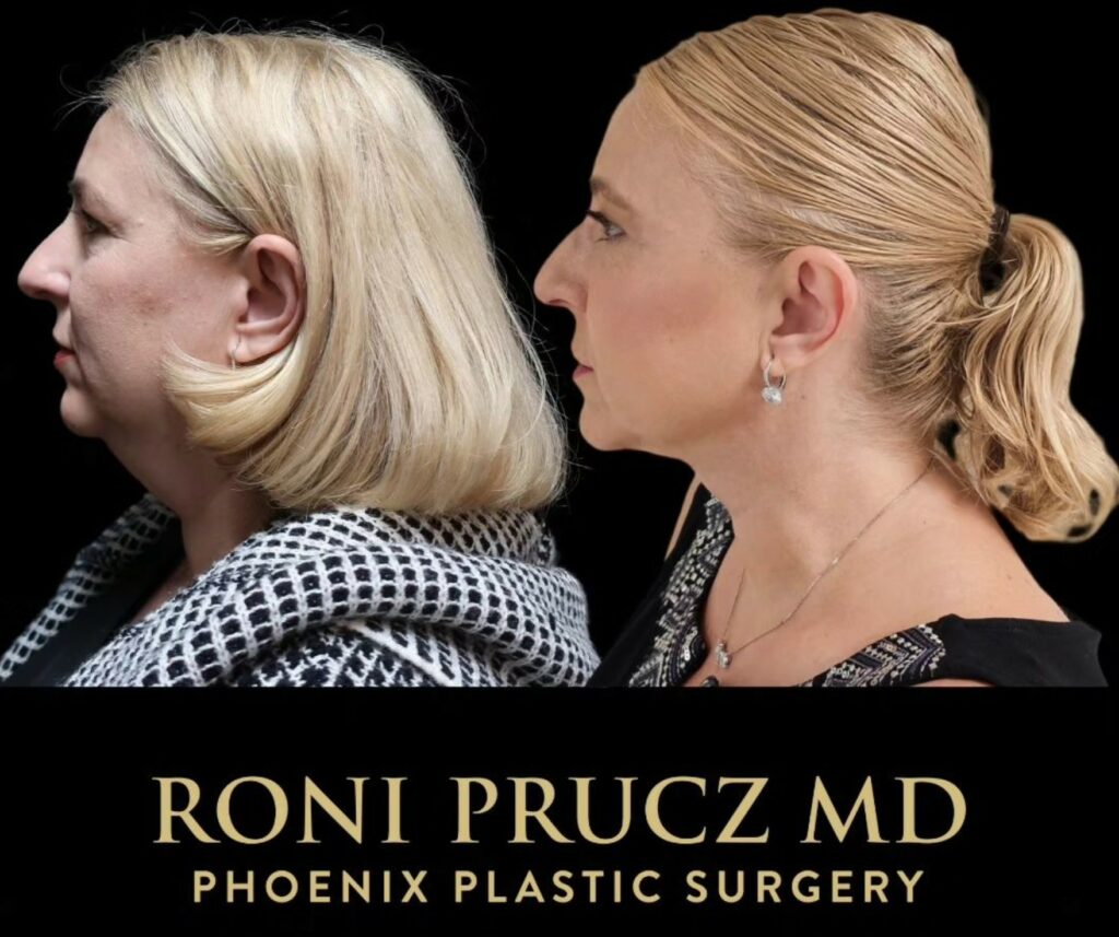Before and After Photo of Female Upper Blepharoplasty and Chin Liposuction Scottsdale Arizona