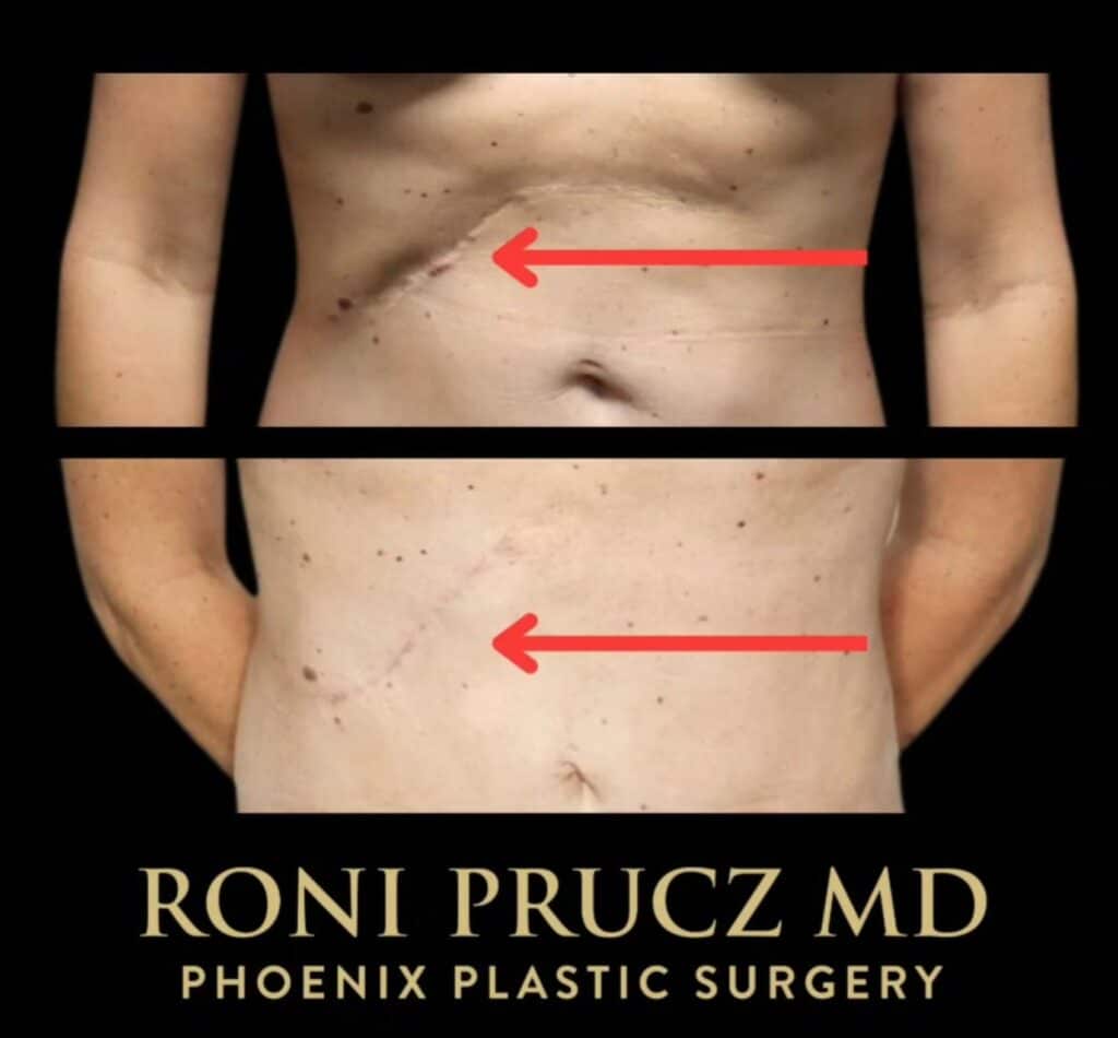 Before and After Photo Abdominal Scar Revision Phoenix Arizona