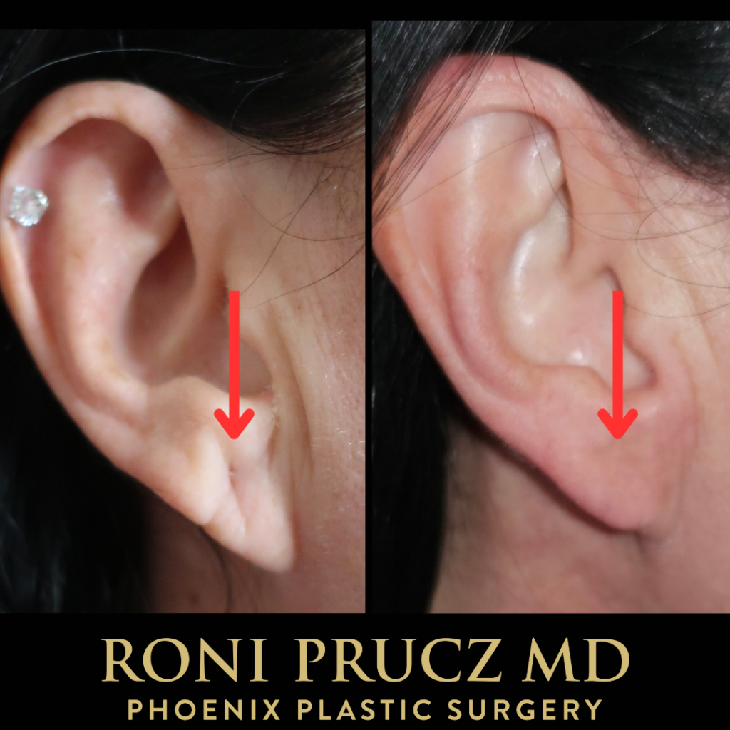 Before and After Photo of Ear Lobule Deformity Corrected with Filler Phoenix Arizona