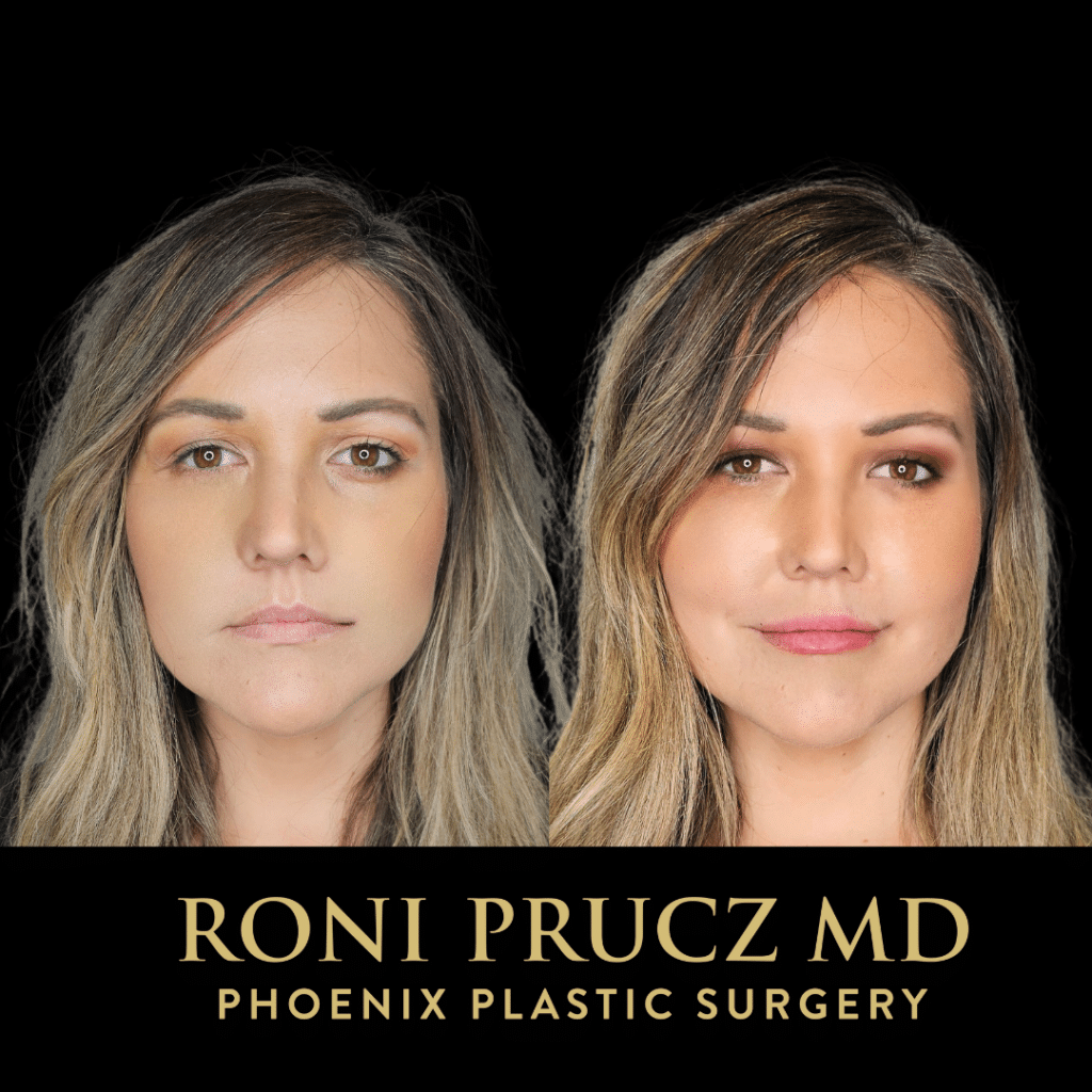 Before and After Photo Lip Augmentation with Filler Scottsdale Arizona