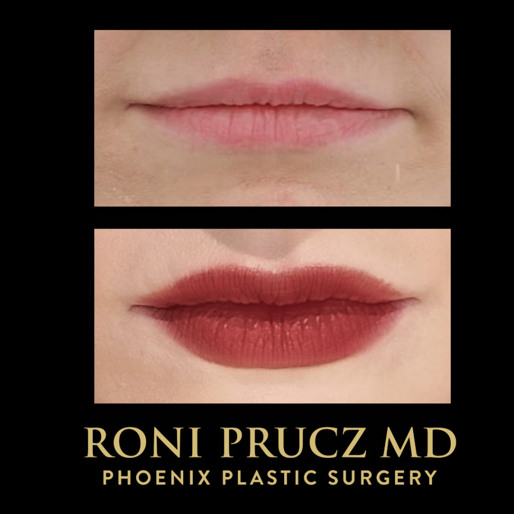 Before and After Photo Lip Augmentation with Filler Scottsdale Arizona