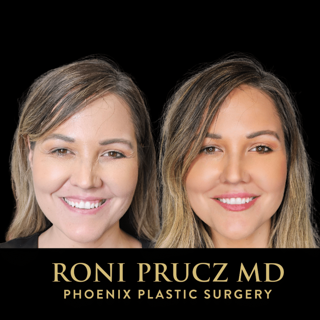 Before and After Photo Lip Augmentation with Filler Phoenix Arizona