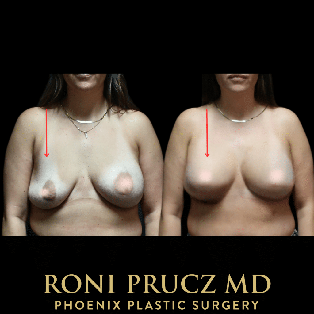 Before and After Photo Breast Mastopexy with Implant Exchange Phoenix Arizona