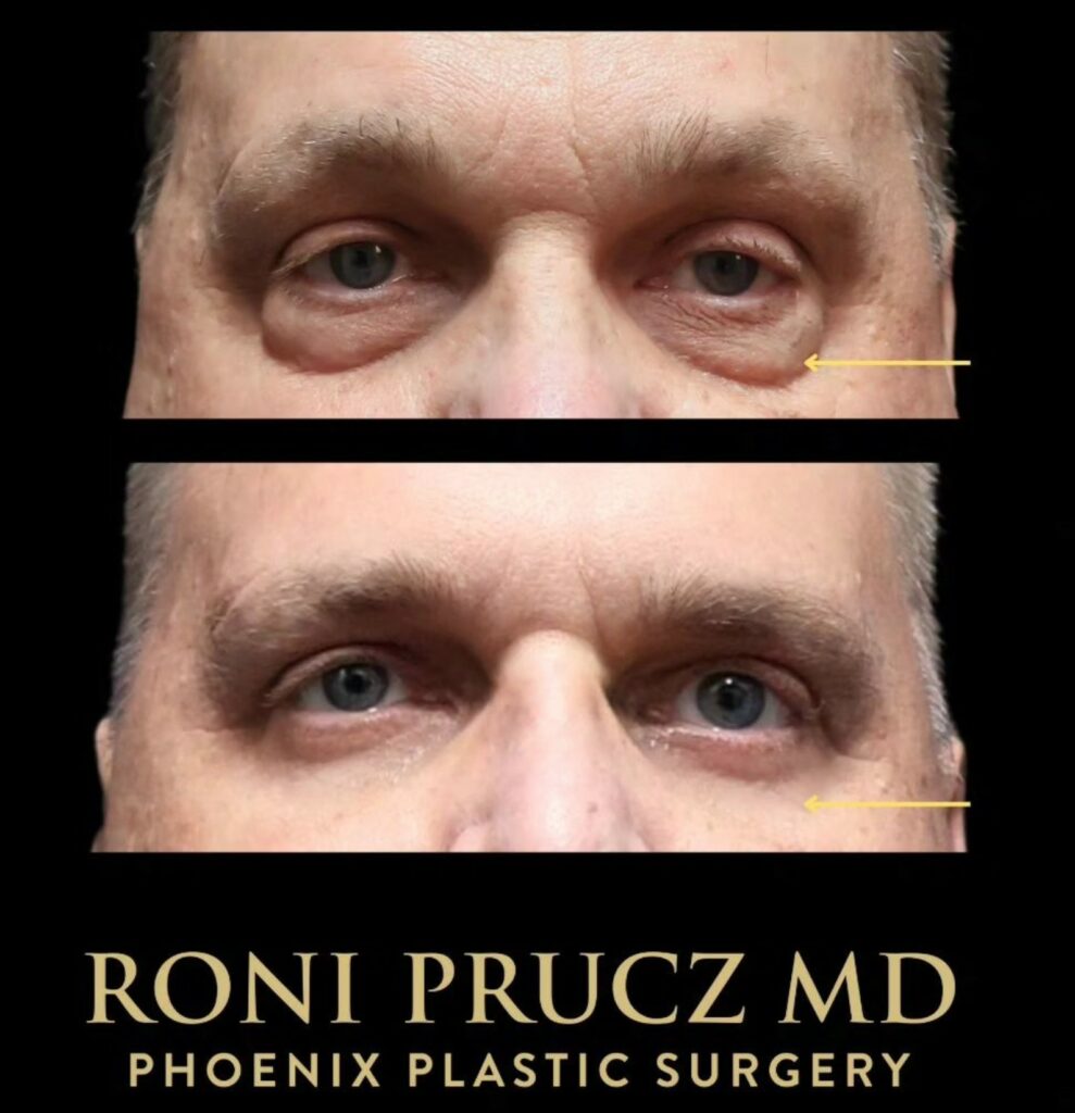 Before and After Photo of Male Upper and Lower Blepharoplasty Phoenix Arizona