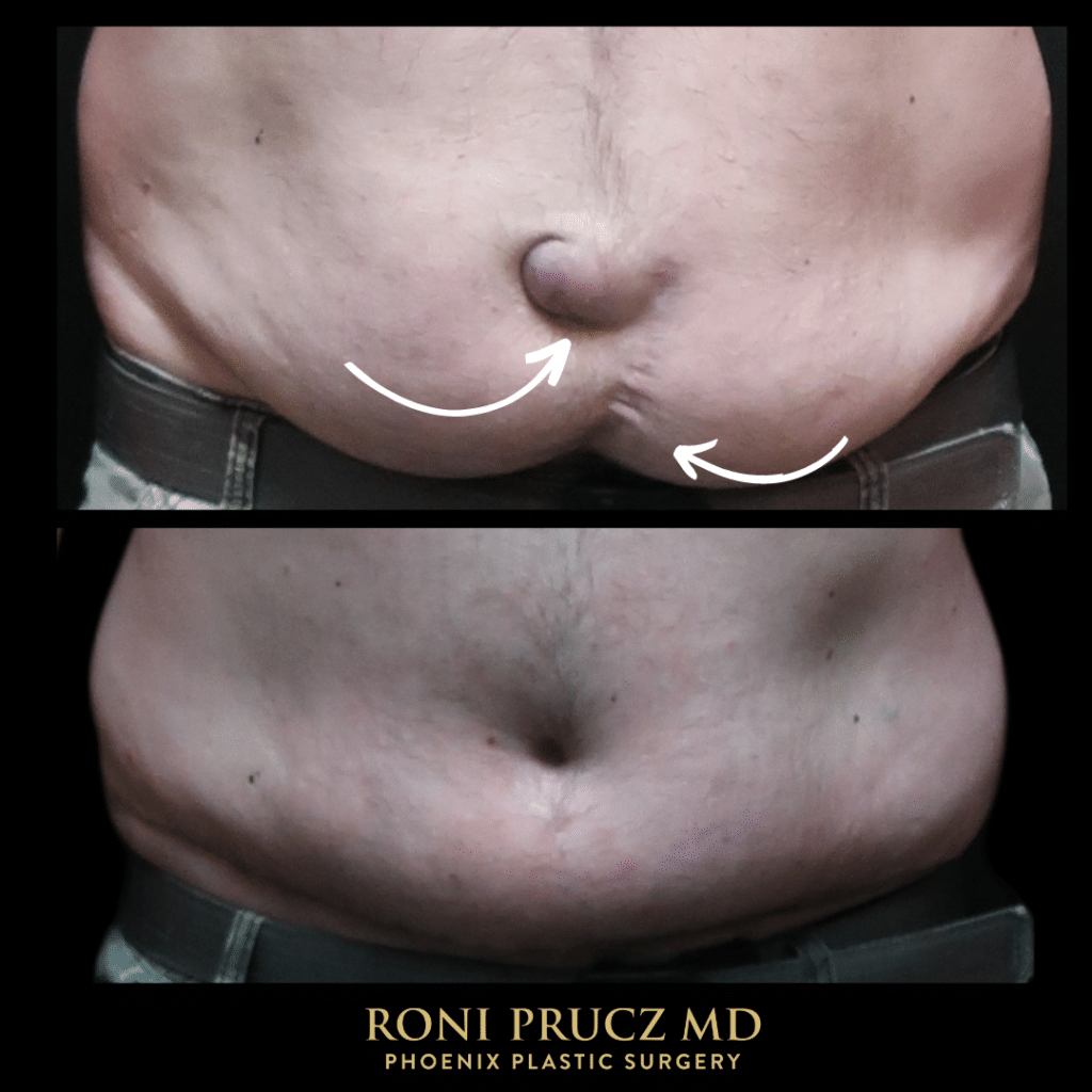 Before and after tummy tuck with hernia repair Phoenix Arizona
