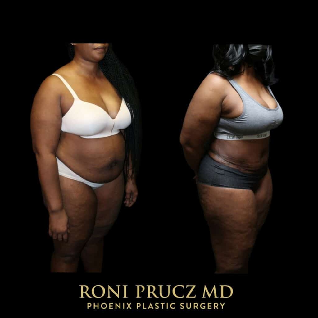 Before and After Photo of Female Abdominoplasty with Rectus Plication Scottsdale Arizona