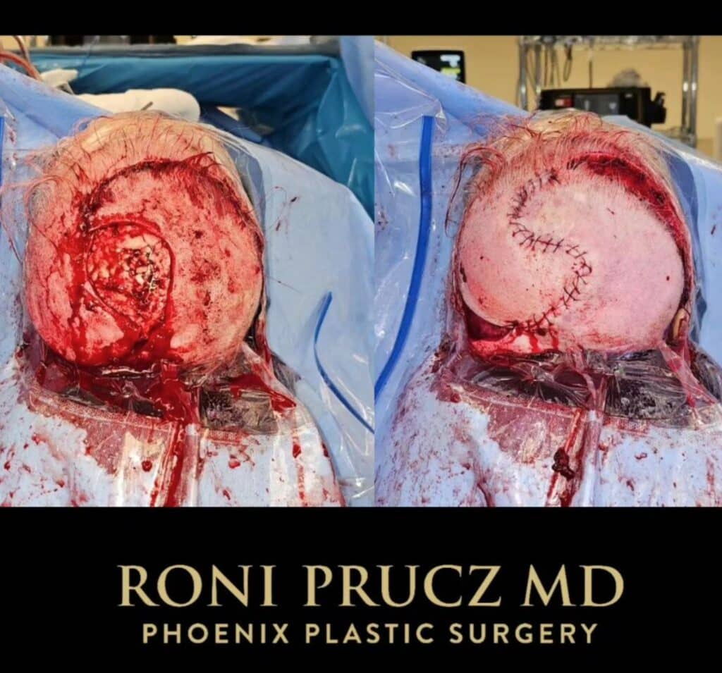 Before and After scalp reconstruction with rotation flaps after cancer resection Scottsdale Arizona