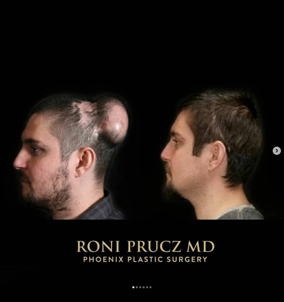 Before and After Scalp Reconstruction with Tissue Expanders Phoenix Arizona