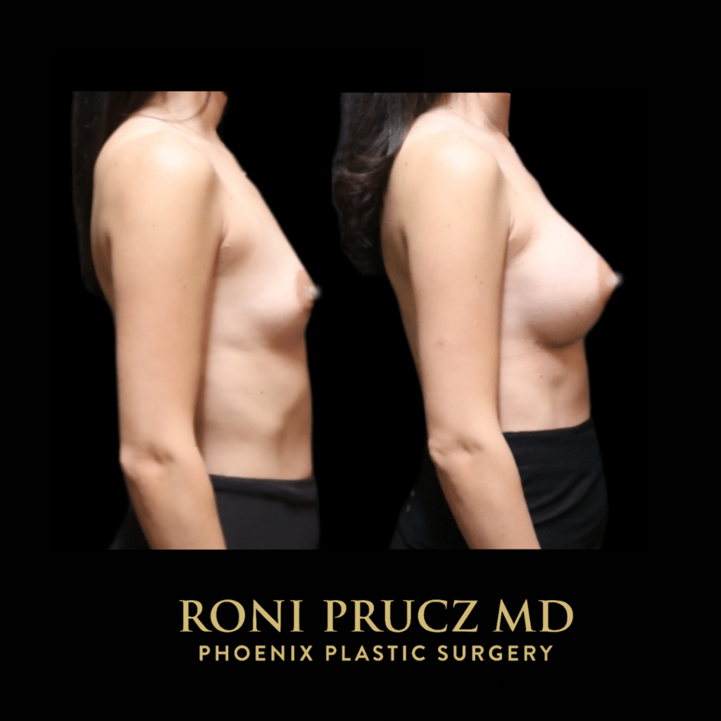 Before and After Photo of Breast Augmentation with Breast Implants Phoenix Arizona