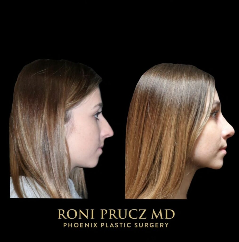 Before and After Photo of Female Tip Rhinoplasty with Osteotomies Scottsdale, Arizona