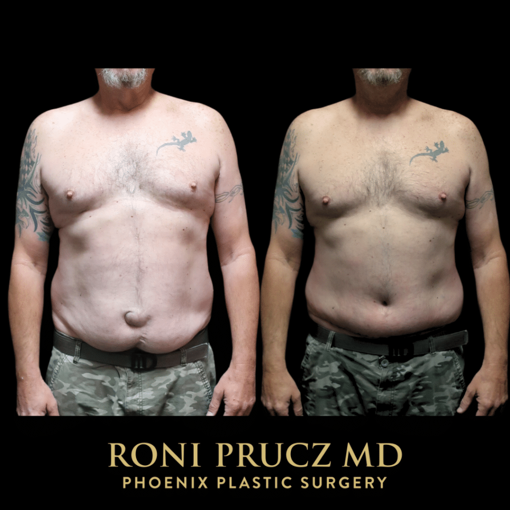 Before and after tummy tuck with hernia repair Phoenix Arizona