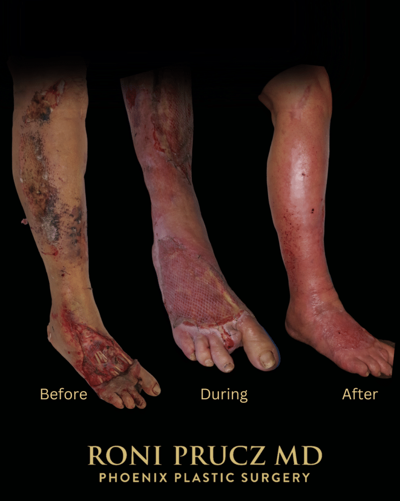 Before and After Photo Right Leg Reconstruction with muscle flap and skin graft Phoenix Arizona