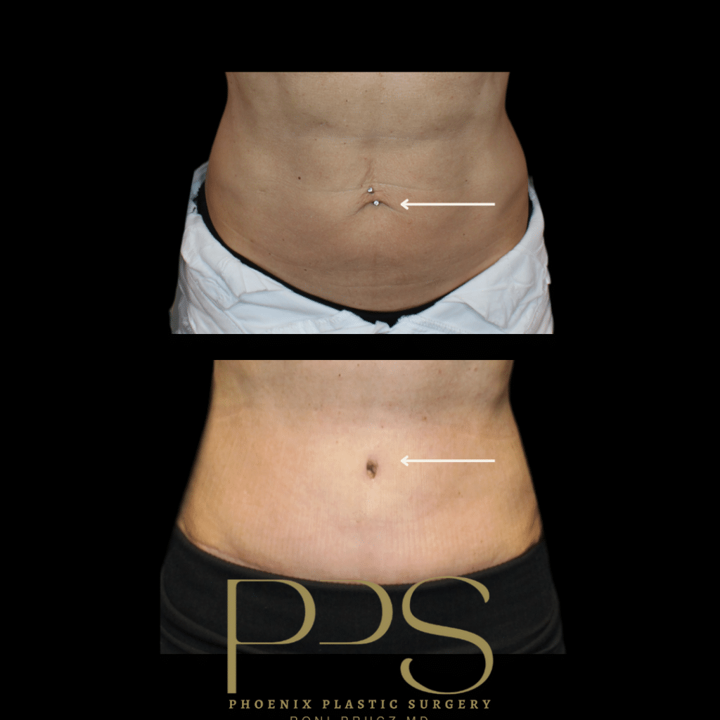 Before and After Photo with Close-up View of the Belly Button in a Thin Patient at Phoenix Plastic Surgery