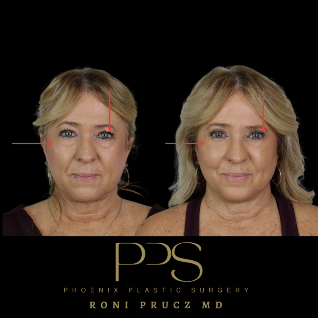 Before and After Photo of Female Upper and Lower Blepharoplasty Scottsdale Arizona