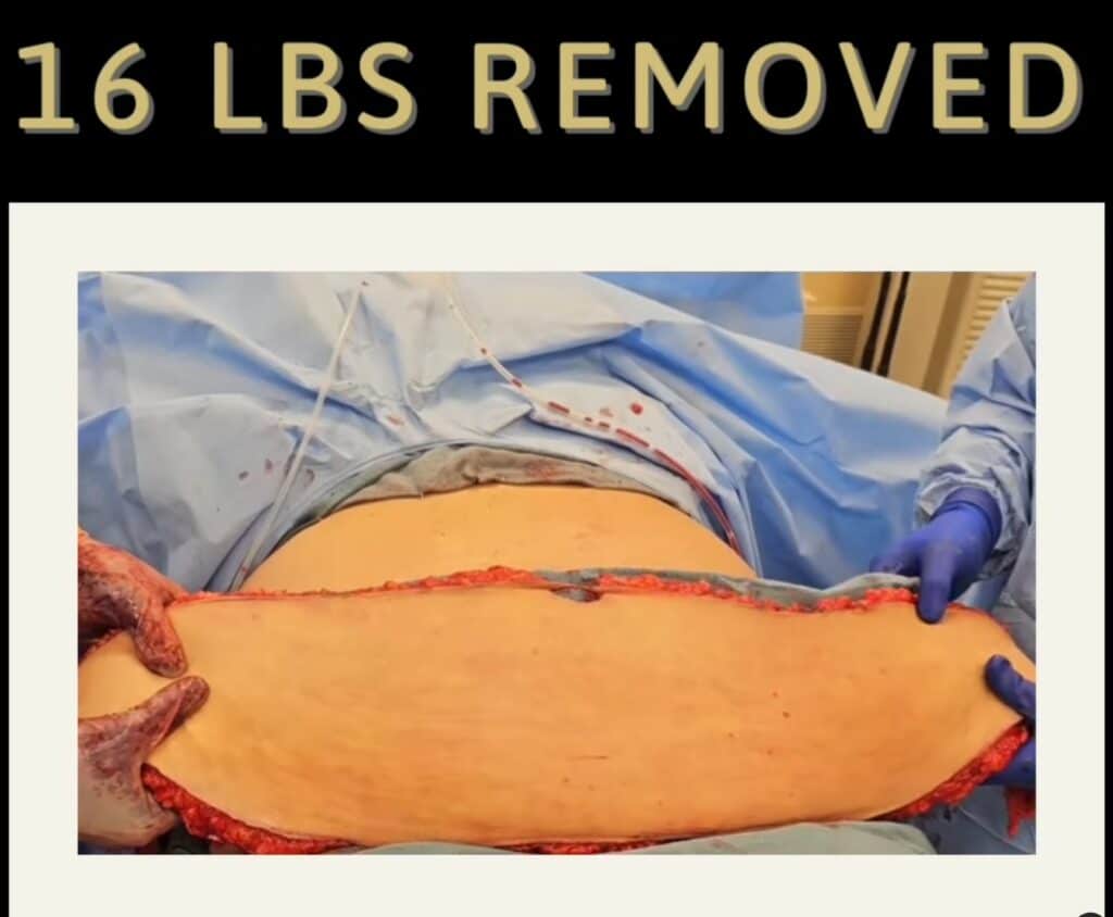 Intraoperative Photo of Large Tummy Tuck Skin and Fat Removal Weighing 16 pounds Phoenix Arizona