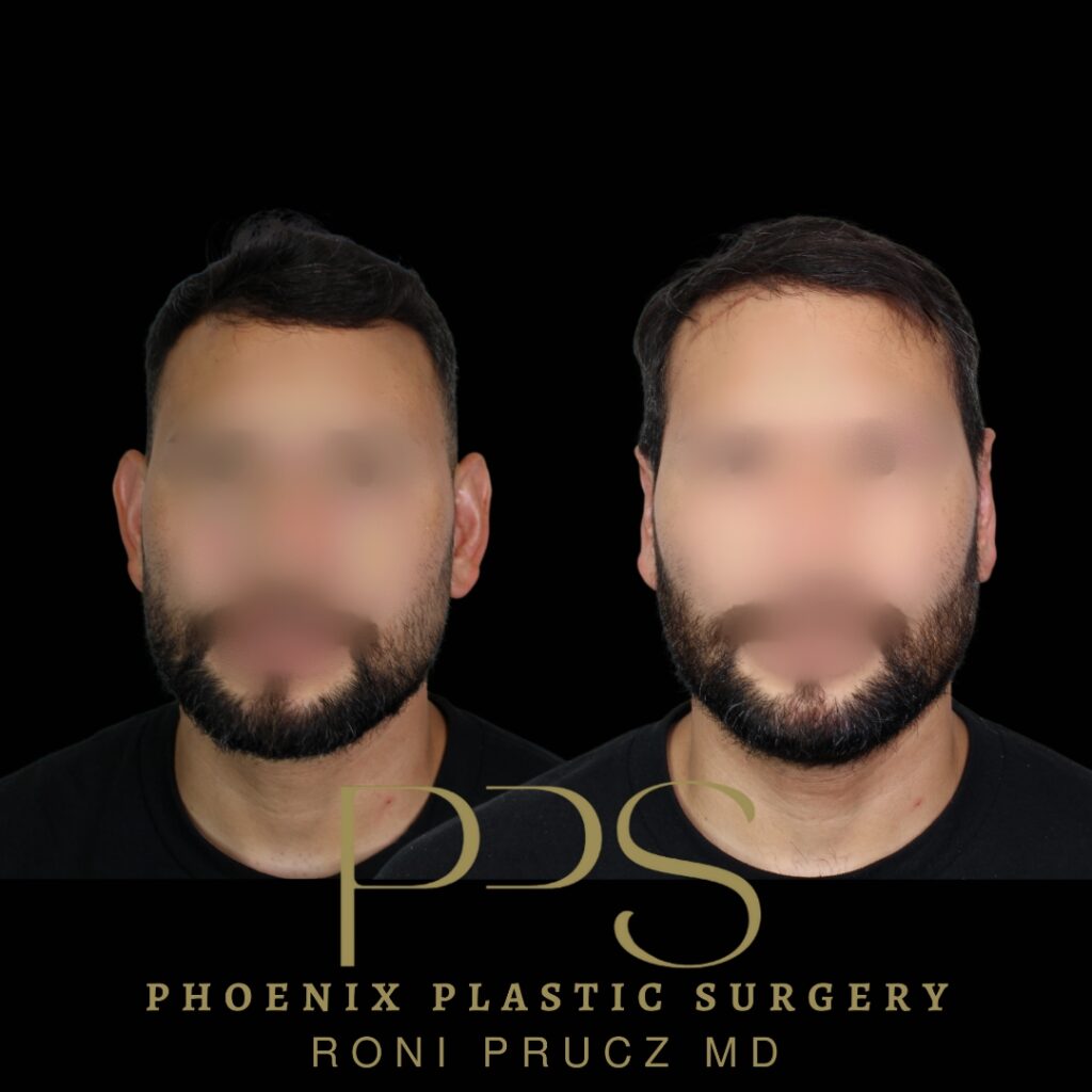 Before and After Photo of Ear Following an Otoplasty Phoenix Arizona