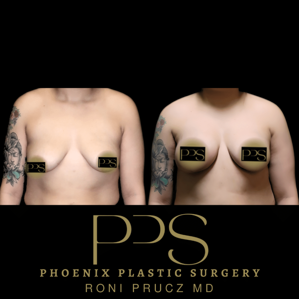 Before and After Photo of Breast Lift with Implants at Phoenix Plastic Surgery