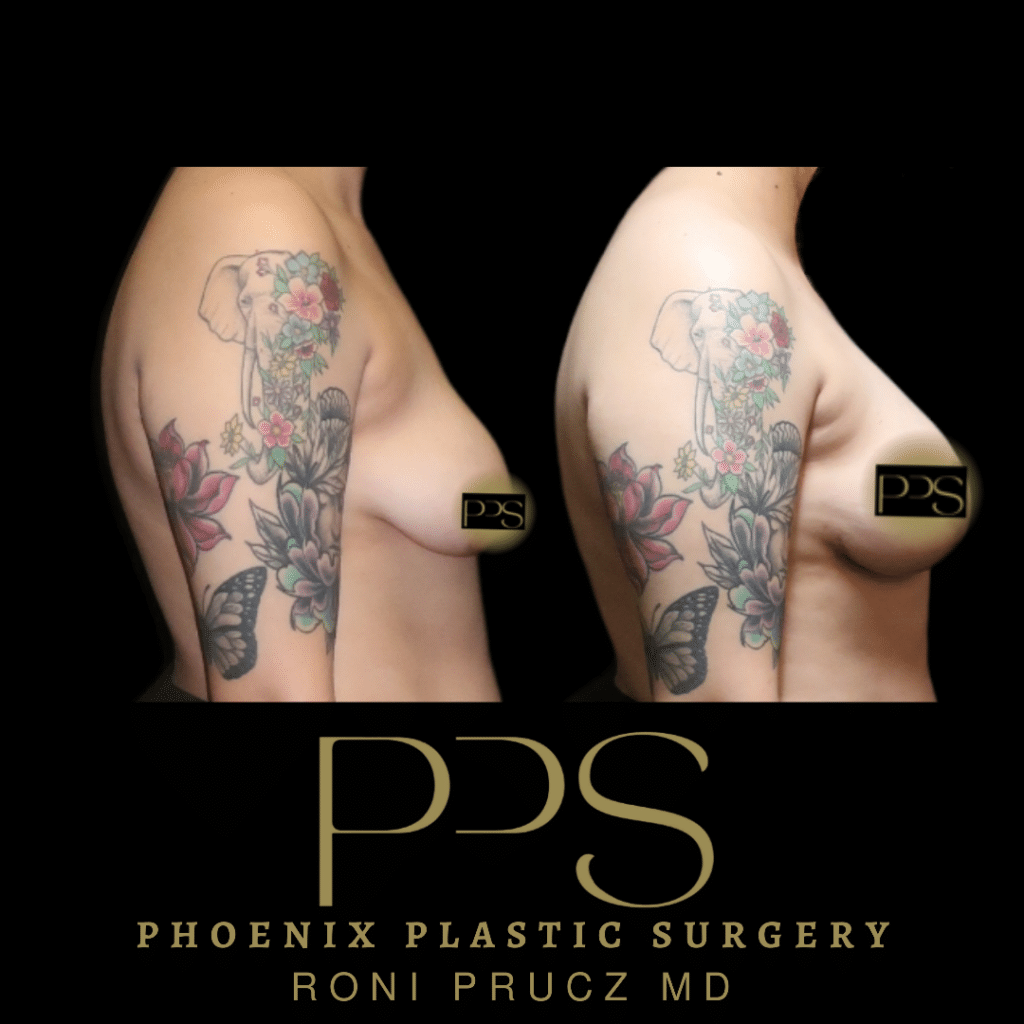 Before and After Photo of Breast Lift with Implants at Phoenix Plastic Surgery