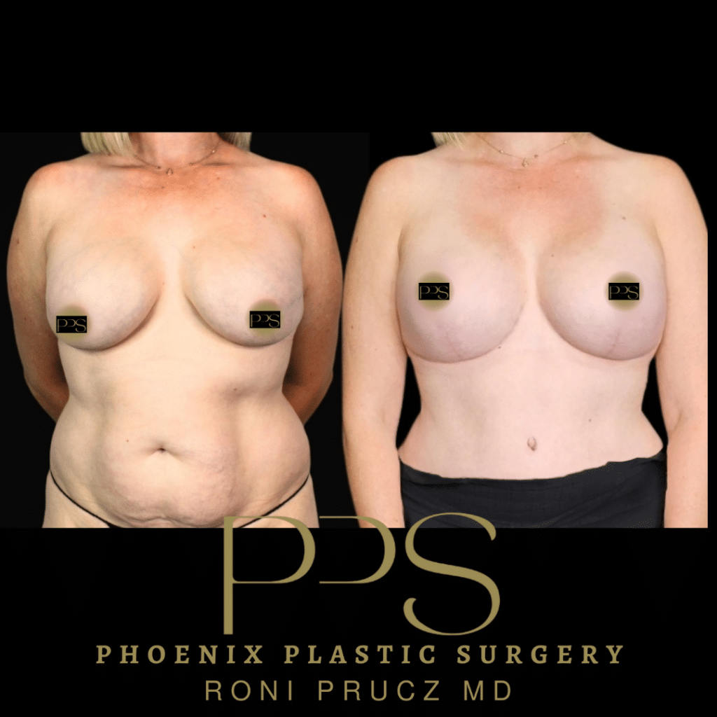 Before and After Photo of Breast Lift with Implants Scottsdale Arizona