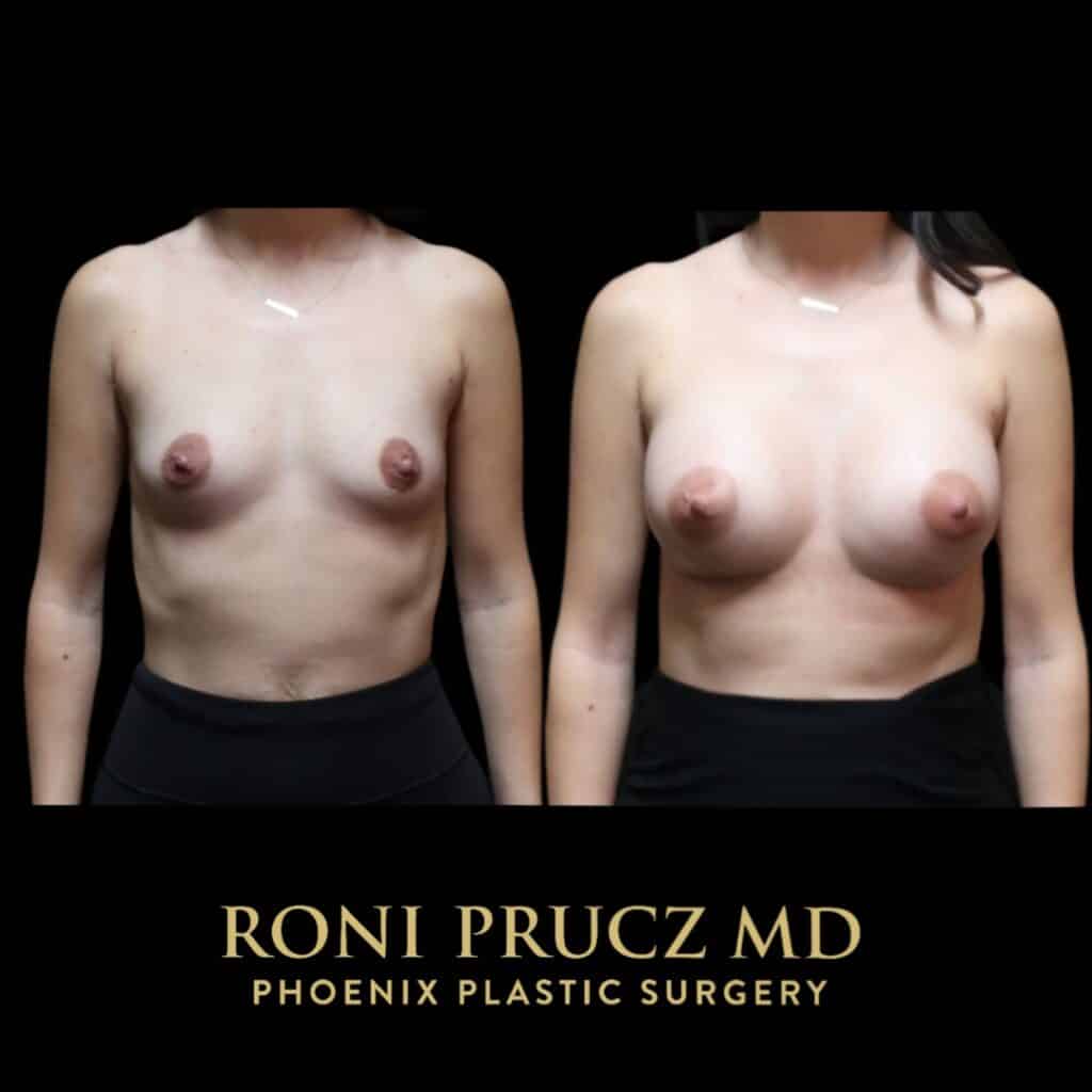Before and After Photo of Breast Augmentation with Breast Implants Scottsdale Arizona