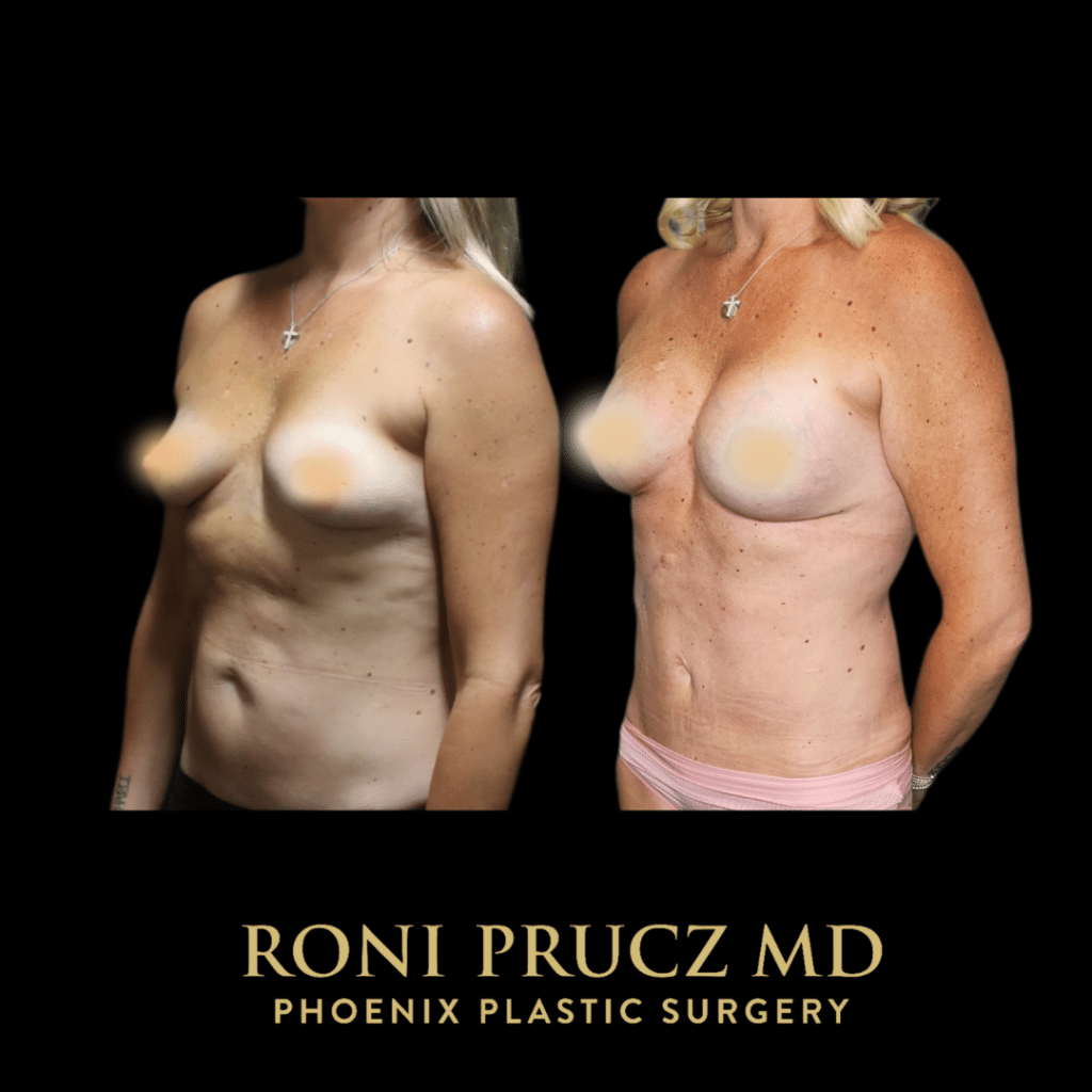 Before and After Photo of Mommy Makeover with Breast Lift with Implants and Tummy Tuck and Scar Revision Phoenix Arizona