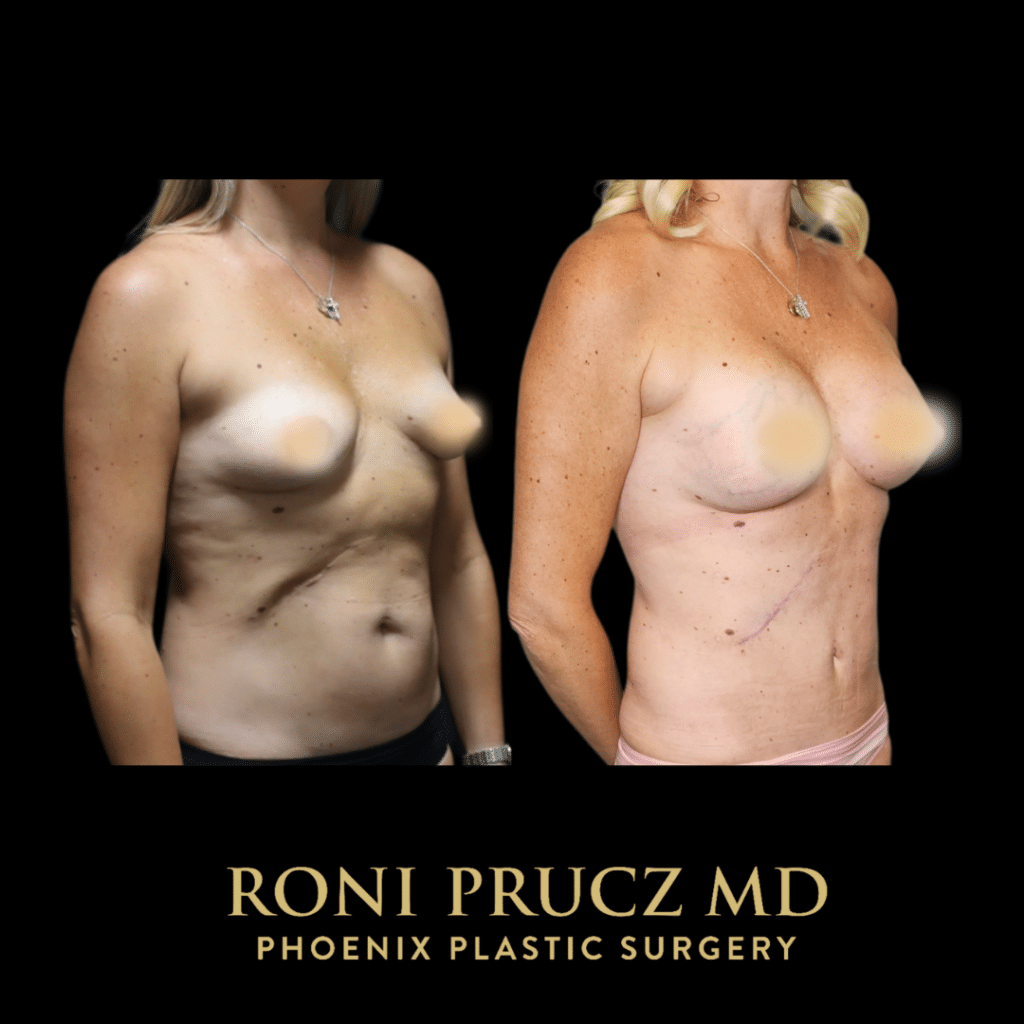 Before and After Photo of Mommy Makeover with Breast Lift with Implants and Tummy Tuck and Scar Revision Phoenix Arizona