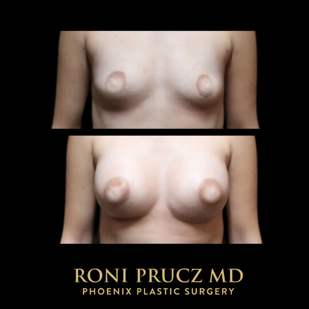 Before and After photo Breast augmentation with breast implants in Scottsdale Arizona