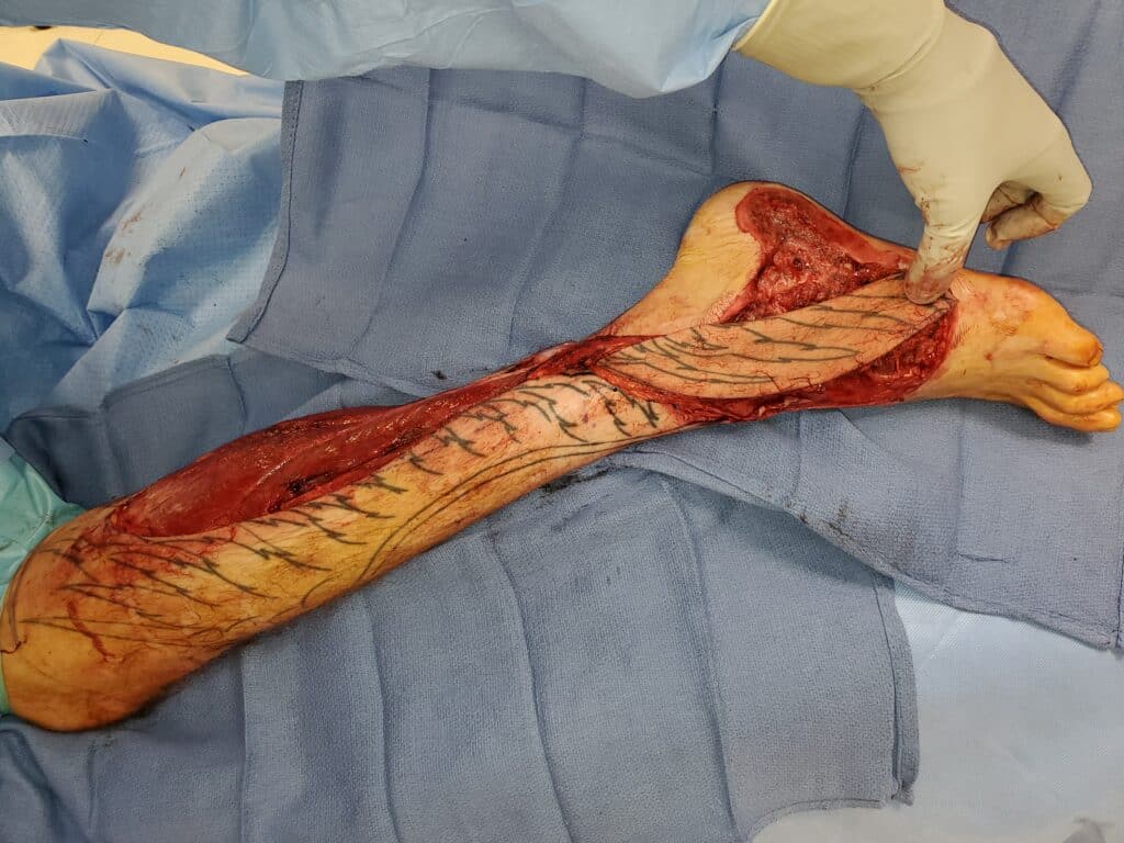 Intraoperative Photo of Sural Flap for Large Defect of Dorsal Foot in Phoenix Arizona