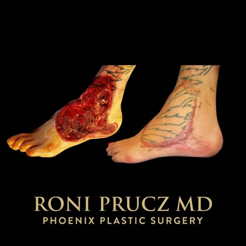 Before and After Photo of Sural Flap for Large Defect of Dorsal Foot in Phoenix Arizona