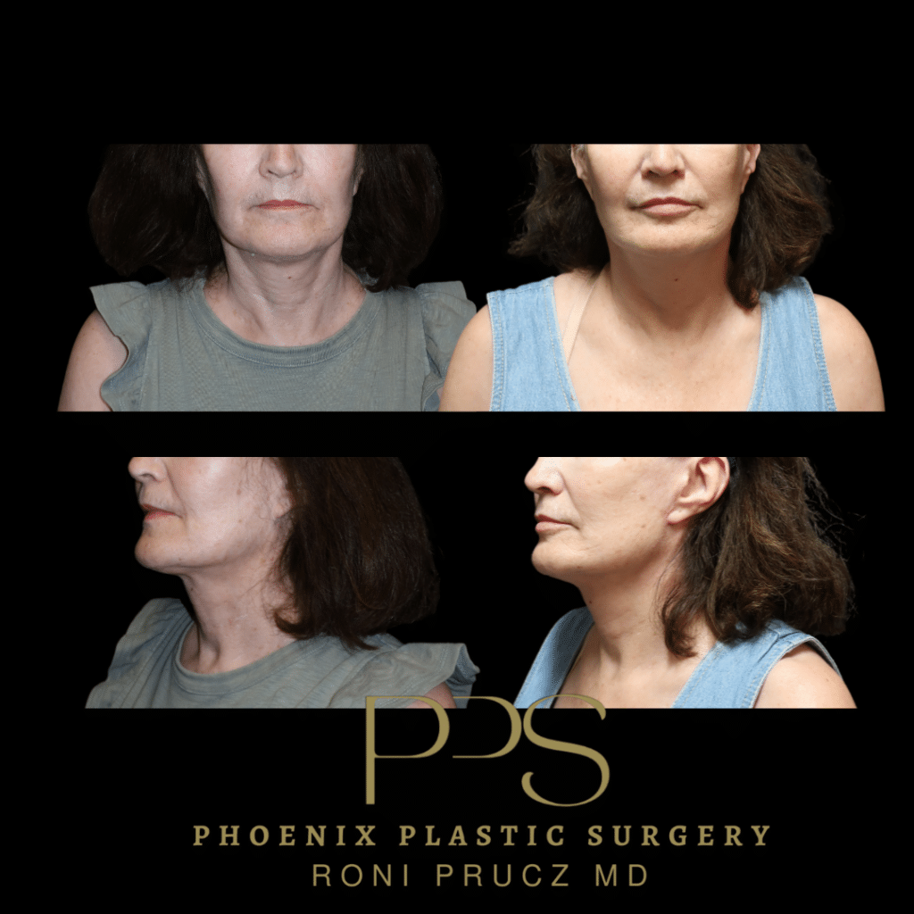 Before and After Photos of Female Neck Lift Phoenix Arizona