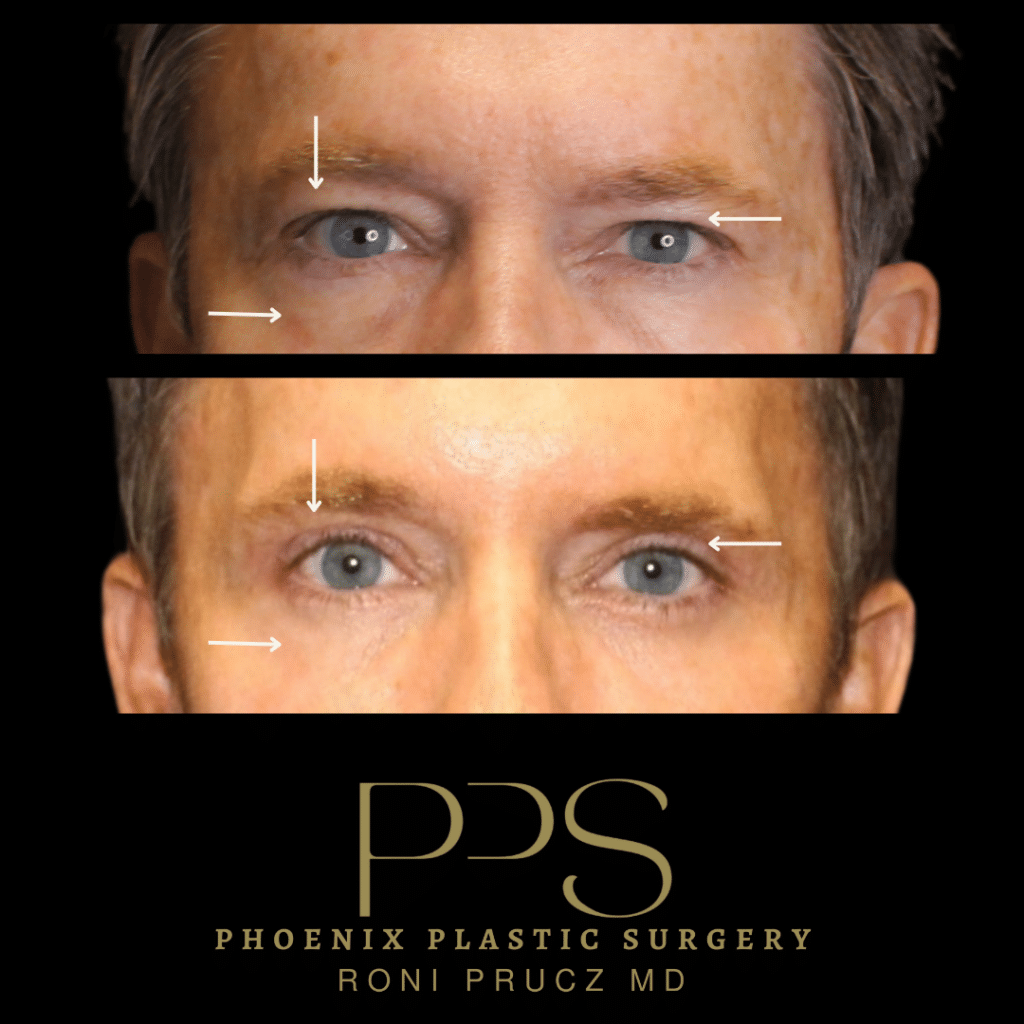 Up Close Photograph of Middle Aged Male After Upper and Lower Eyelid Surgery Scottsdale Arizona