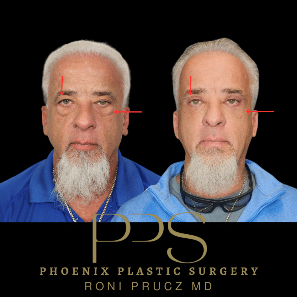 Before and After Photo of Male Upper and Lower Eyelid Surgery Phoenix Arizona