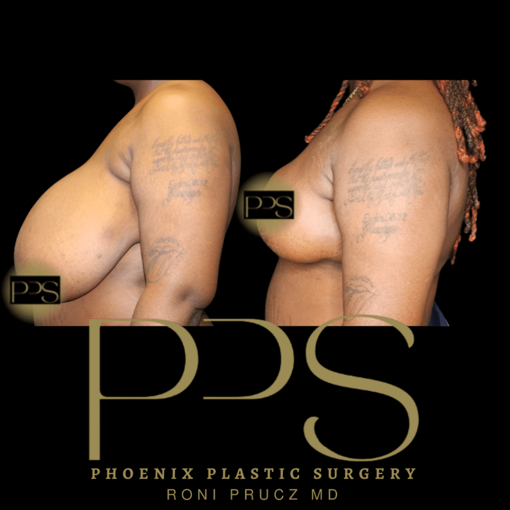 Before and After Photo of Very Large Breast Reduction Lateral View Phoenix Arizona