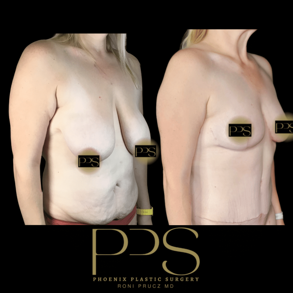 Before and After Photo of Mommy Makeover with Breast Lift and Tummy Tuck Phoenix Arizona