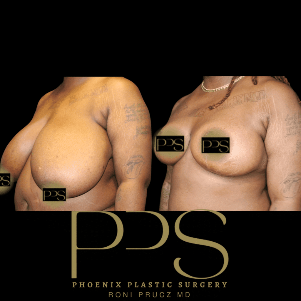 Before and After Photo of Very Large Breast Reduction Oblique View Scottsdale Arizona