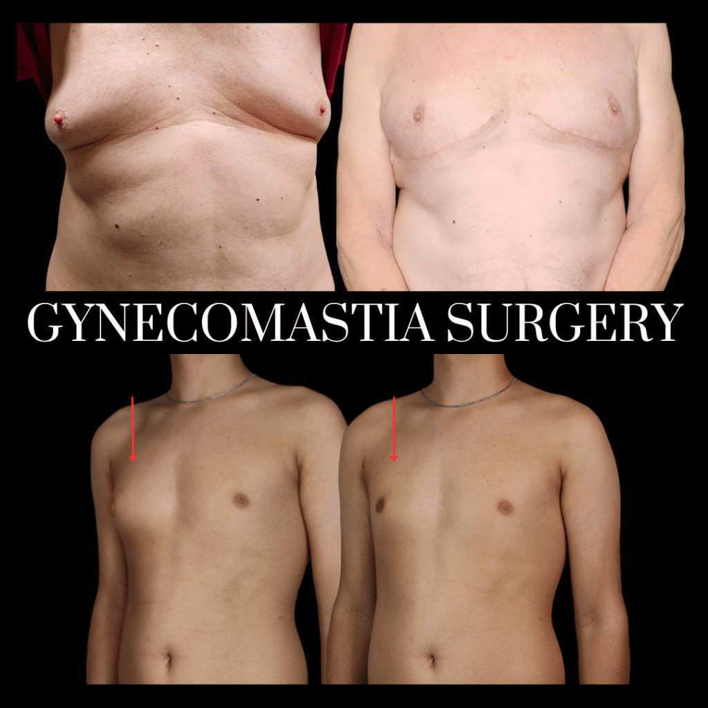 Before and After Photos of Gynecomastia Surgery with Dermoglandular Pedicle vs Excision and Liposuction Phoenix Arizona