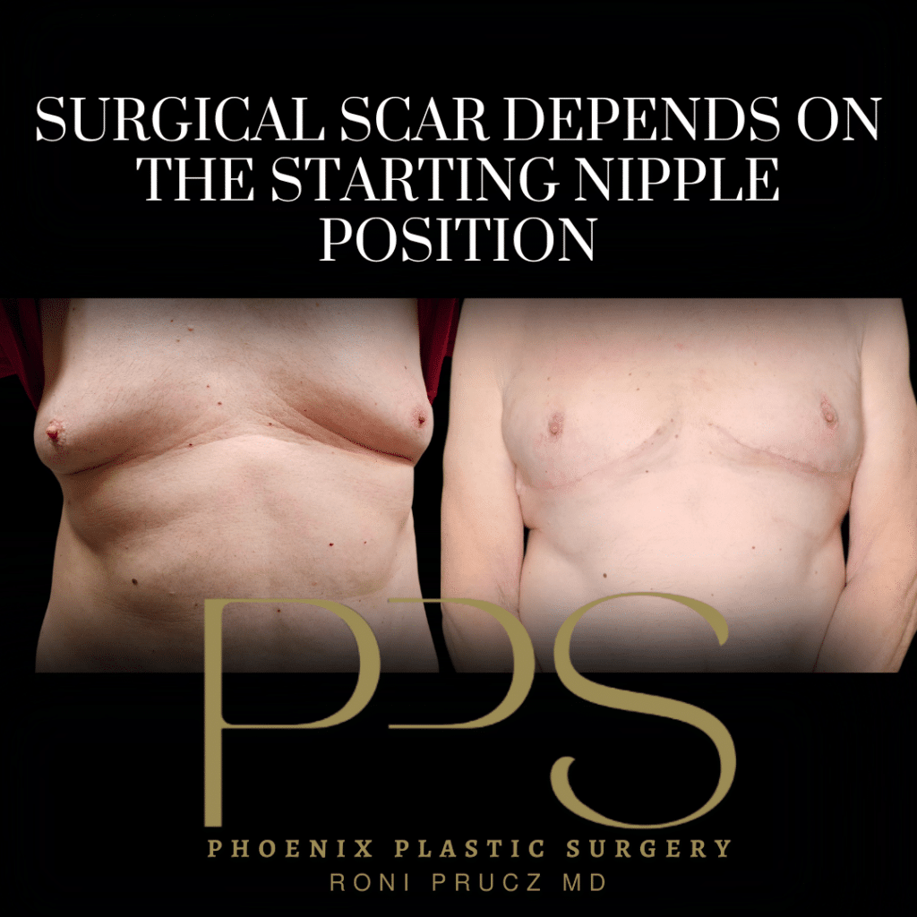 Before and After Photo of Gynecomastia Surgery with Dermoglandular Pedicle Scottsdale Arizona