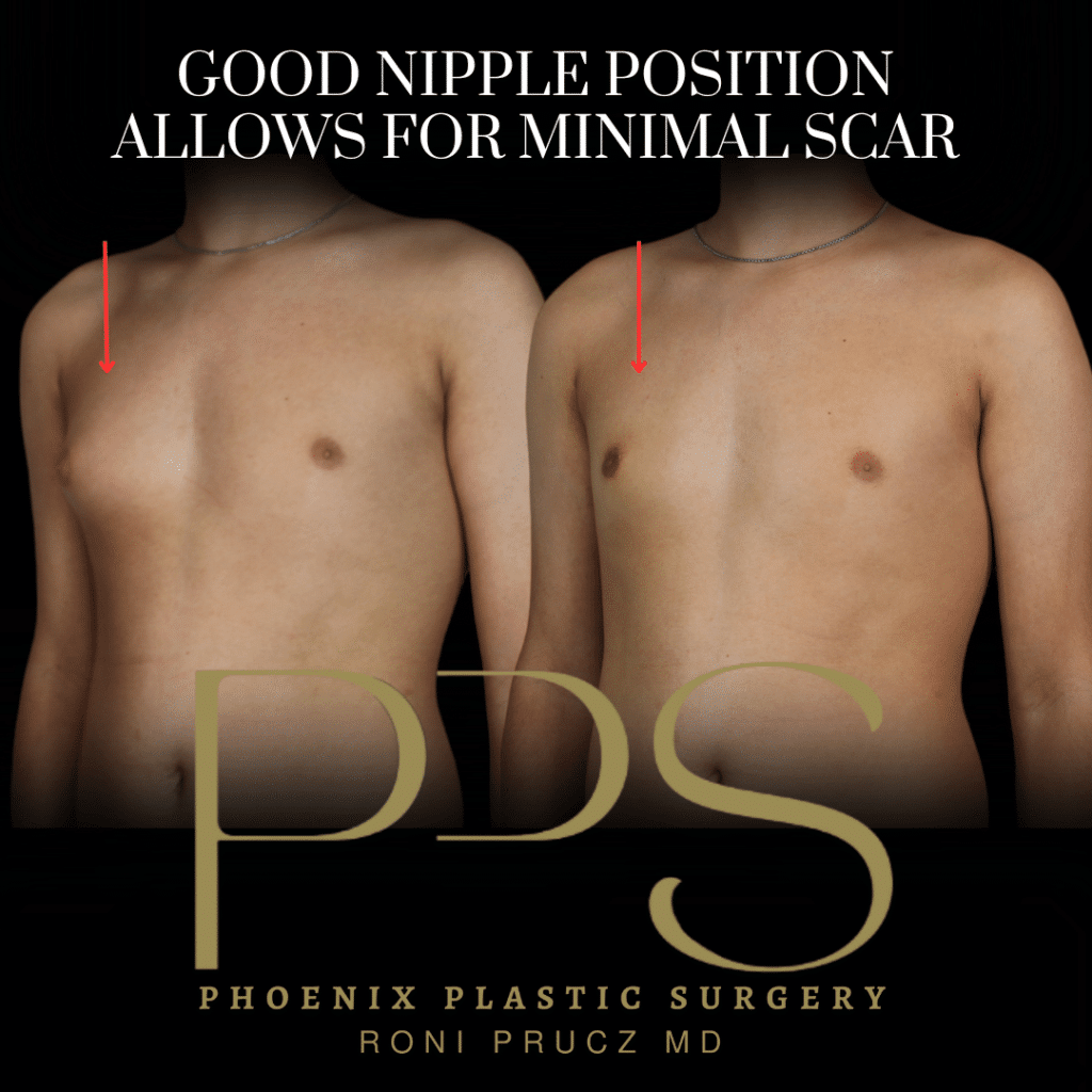 Before and After Photo of Gynecomastia Surgery with Excision of Glandular Tissue and Liposuction Scottsdale Arizona