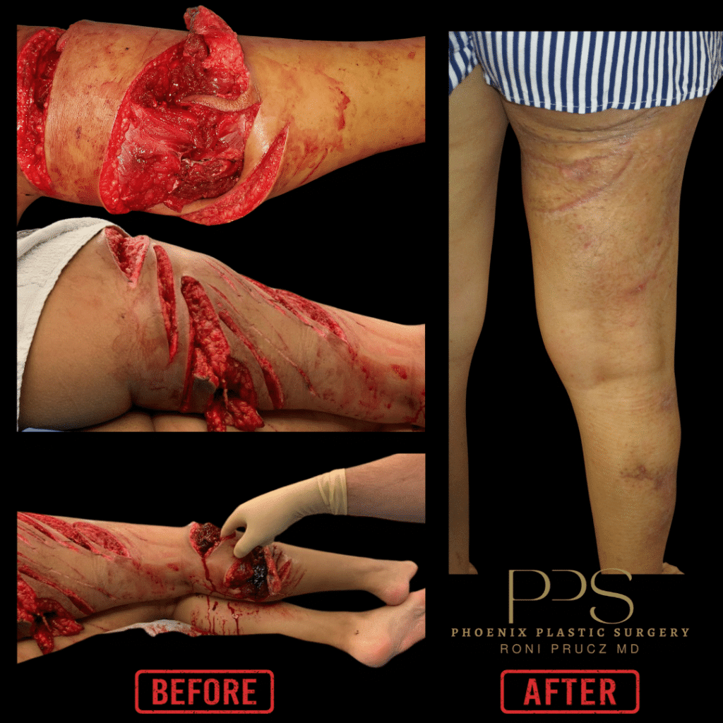 Before and After Posterior Photo of Boat Propeller Injury Repair Scottsdale Arizona