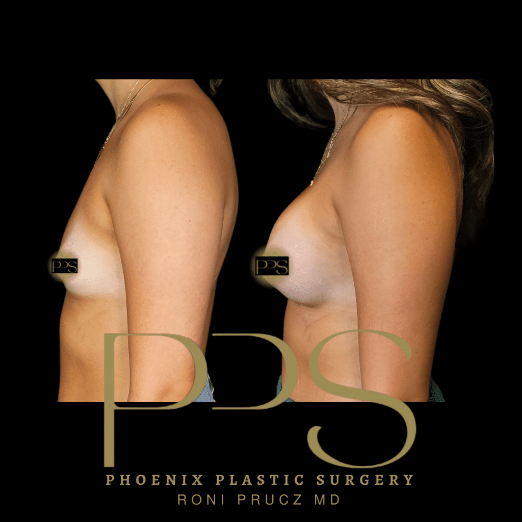 Before and After Photograph of Breast Augmentation Paradise Valley Arizona