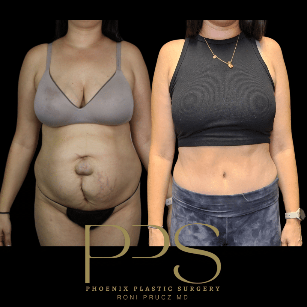 Before and After Photograph of Hernia Repair and Tummy Tuck Phoenix Arizona