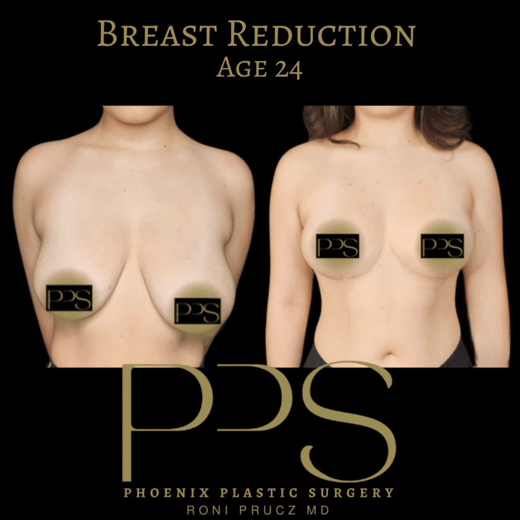 Before and After Photo Breast Reduction Paradise Valley Arizona